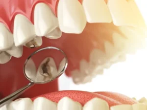 Cisos Odontologia - Tratamento de Cáries