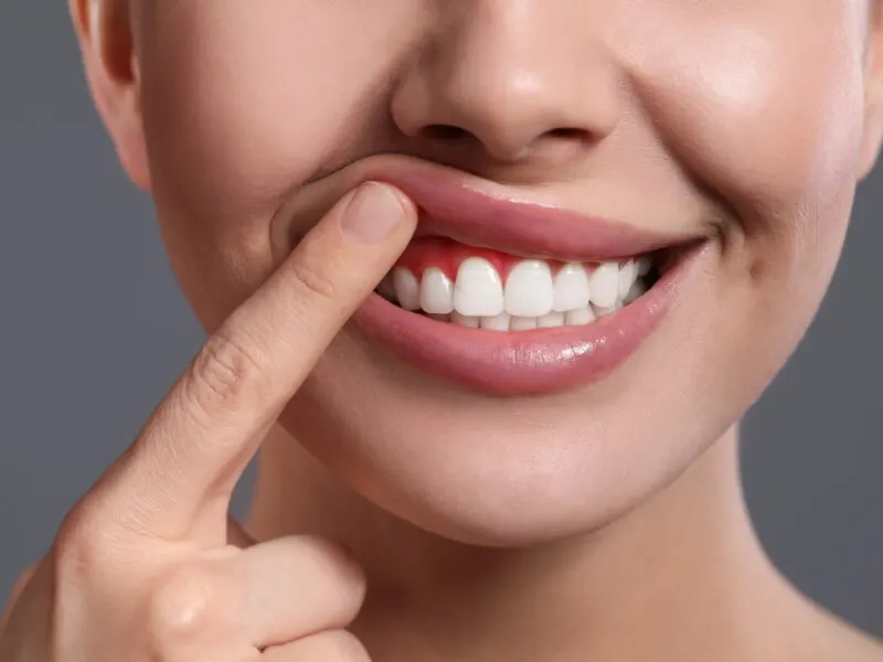 Cisos Odontologia - Tratamento de Gengiva