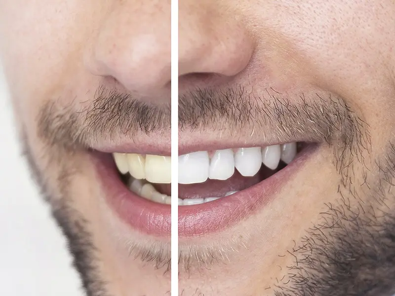 Clareamento Cisos Odontologia