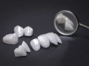 Facetas Cisos Odontologia
